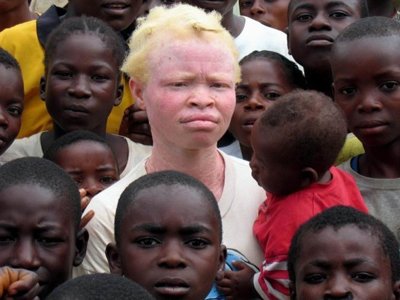 В Танзании арестовали более 200 человек по делу об убийстве альбиносов колдунами
